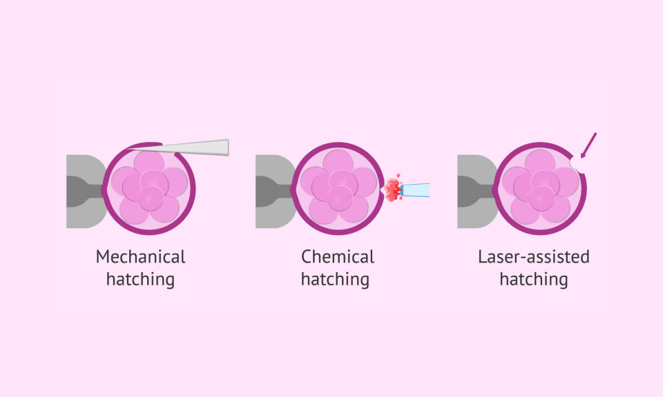 Laser Assisted Hatching (LAH)